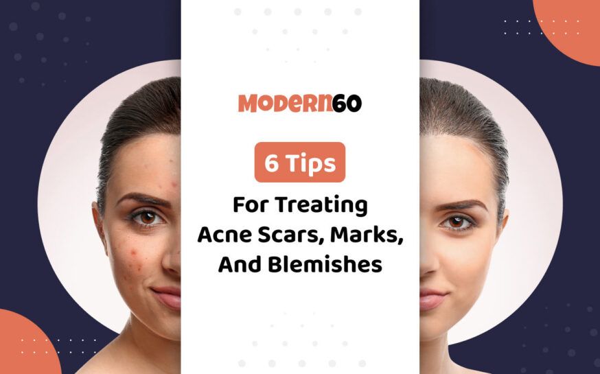 6 useful tips to treat acne scars, marks, and blemishes