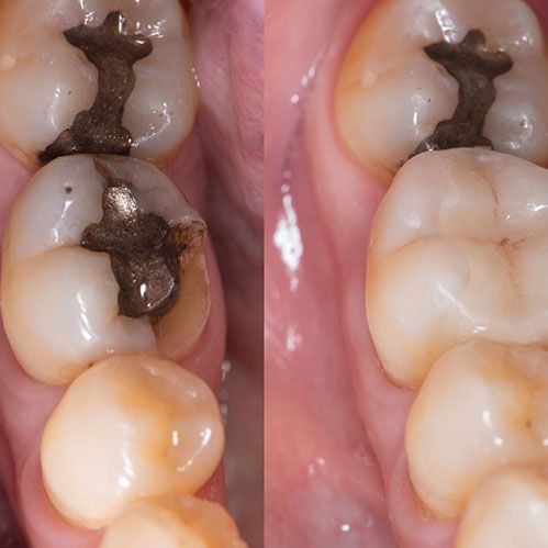 Before and After of Dental cure