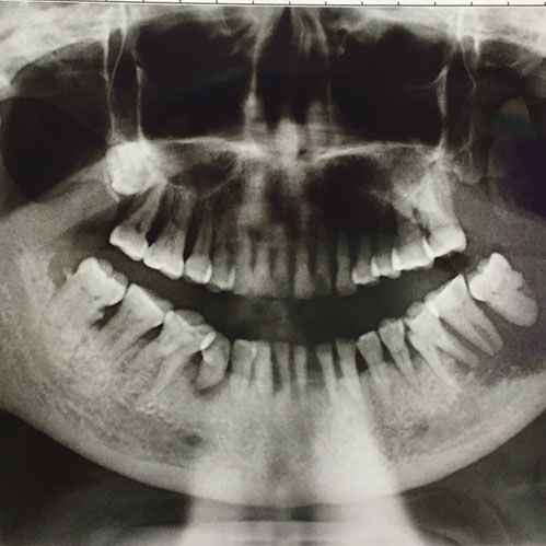 X ray of Mouth cancer
