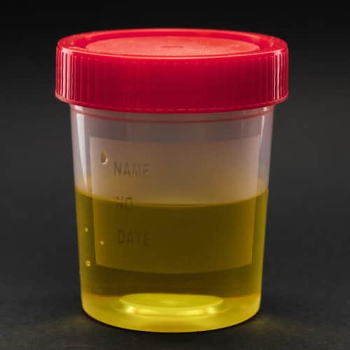 Dark colored Urine in elderly