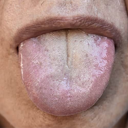 Dry Mouth in elderly