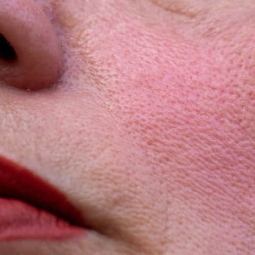 Flushed Skin in elderly