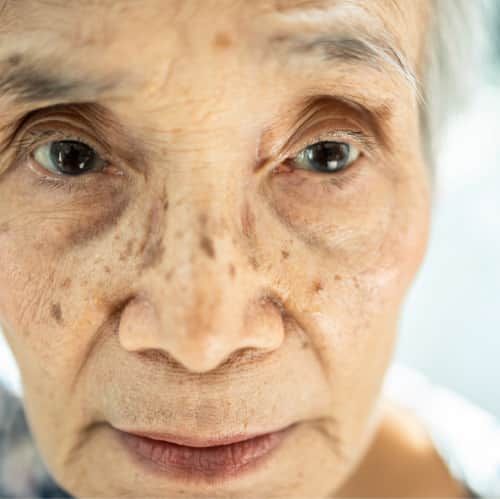 Sunken Eye in elderly women