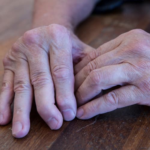Psoriatic arthritis