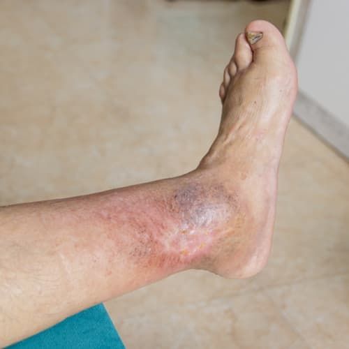 Delayed wound healing, leading to more open sores and ulcers in elderly