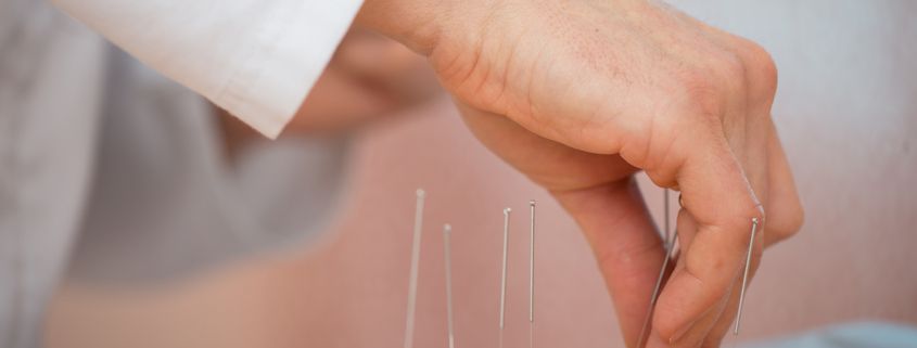 Opting for acupuncture therapy