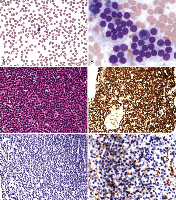 Most people with myeloma have the M protein in their blood or urine.
