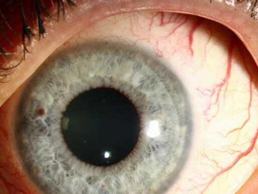 Forskolin supplements are often used to manage glaucoma, a group of eye conditions.