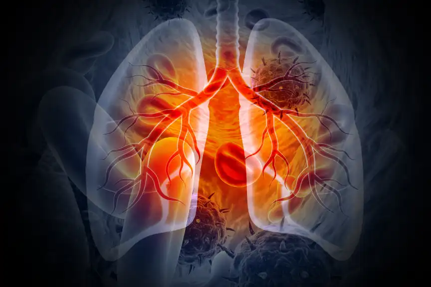 Metastatic lung cancer representation 