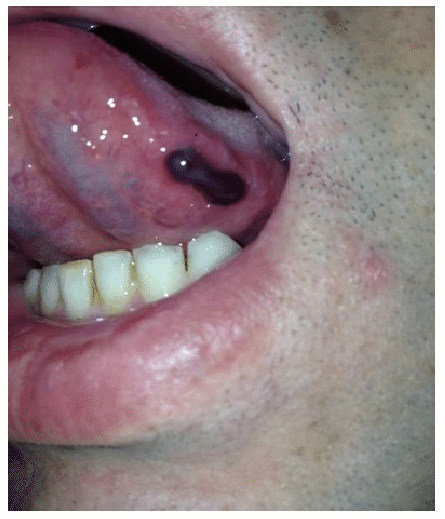 Unexplained bleeding from the tongue