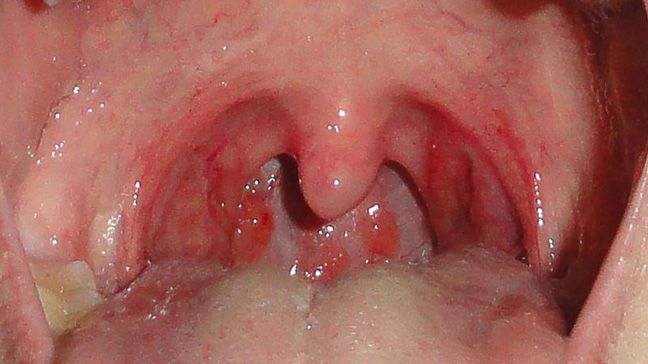 Persistent sore throat