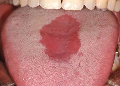 A patch on the tongue