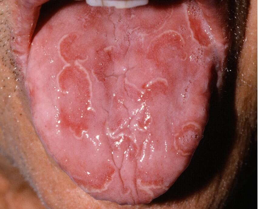 A tongue sore that does not heal